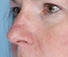 Lesion of the nose