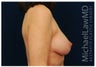 Breast Lift