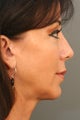 Female Chin Implant