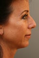 Female Chin Implant