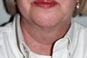 Facial Liposuction