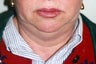 Facial Liposuction