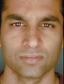 Indian Male Rhinoplasty
