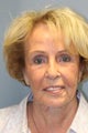 LiteLift™ on 82-year-old Woman