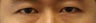 Revision Bilateral Asian Eyelid Surgery