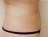 Smartlipo of the abdomen