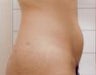 Smartlipo of the abdomen
