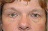 Upper and Lower Blepharoplasty