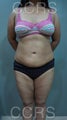 27 yr. old female with generalised fat deposits