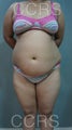 27 yr. old female with generalised fat deposits