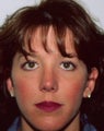 Browlift Rejuvenates Face