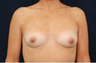 Breast Augmentation