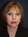 50 Year Old Female with Eyelid Surgery, Laser Resurfacing and Facelift