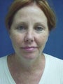 50 Year Old Female with Eyelid Surgery, Laser Resurfacing and Facelift