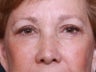 Brow Lift