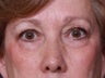 Brow Lift
