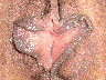Labiaplasty