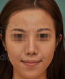 Revision Asian Nose Surgery
