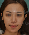 Revision Asian Nose Surgery