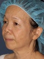 50 year old Asian female treated for brown spots and age spots