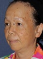 50 year old Asian female treated for brown spots and age spots