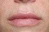 Lip treatment with Restylane®