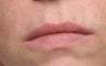Lip treatment with Restylane®
