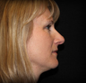 Rhinoplasty