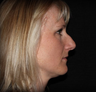 Rhinoplasty