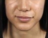 Lip augmentation with Juvederm Volbella