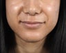 Lip augmentation with Juvederm Volbella