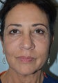 56 year old Female treated for under eye bags and prejowls around the the chin