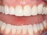 Bonding with Composite to Repair Slanted Smile
