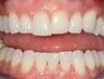 Bonding with Composite to Repair Slanted Smile