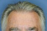 57 Year Old Male Treated with No-Scar NeoGraft FUE procedure