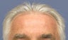 57 Year Old Male Treated with No-Scar NeoGraft FUE procedure