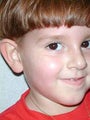 Male Dog Attack Facial Reconstruction in Child