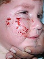 Male Dog Attack Facial Reconstruction in Child