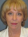 Brow Lift, Liposuction, LiteLift™ on 56-year-old Woman