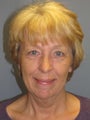 Brow Lift, Liposuction, LiteLift™ on 56-year-old Woman