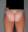 Buttock Augmentation
