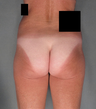 Buttock Augmentation