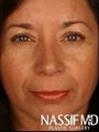 Female Primary Rhinoplasty