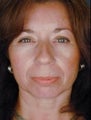 Female Primary Rhinoplasty