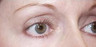 Eyelid surgery