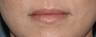 Before & After Lip Augmentation