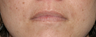 Before & After Lip Augmentation