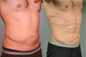 36 year old male Smartlipo abdomen 8 months post op