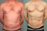 36 year old male Smartlipo abdomen 8 months post op