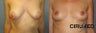 Breast Lift